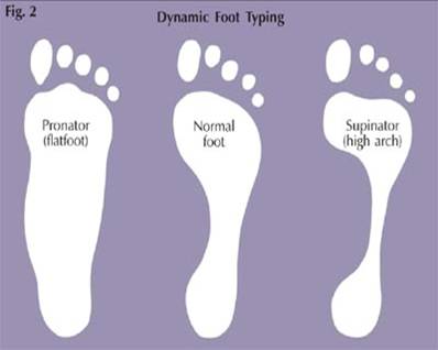 Plantar Faciitis Illustration